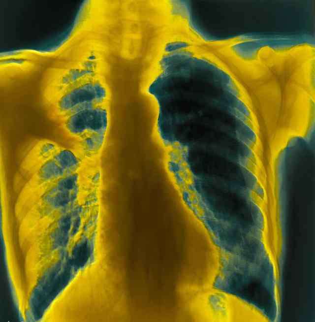 大叶性肺炎和小叶性肺炎的区别 间质性肺炎、支气管肺炎、大叶性肺炎影像诊断的区别