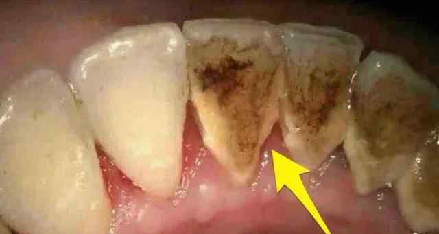 怎样去除牙垢 清除牙垢有几种方法？