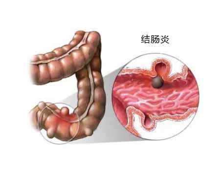 怎么确定是肠胃炎 怎么判断是不是肠炎？