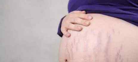 防止妊娠纹 几个方法告诉宝妈们，教你如何预防妊娠纹？