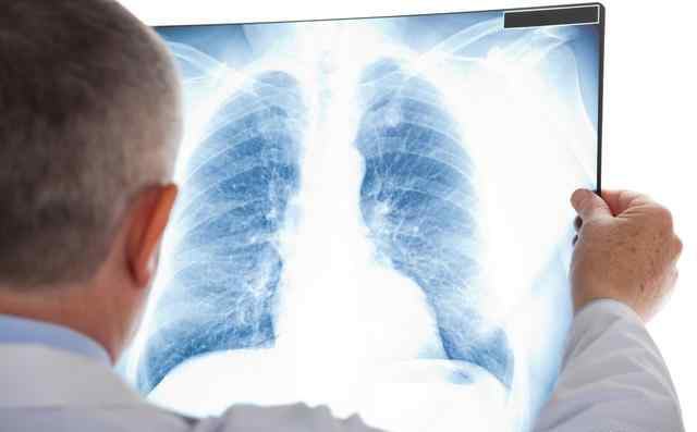 右肺纤维灶能活几年 体检发现肺局部纤维灶会演变成肺纤维化吗？有人说只能活2-3年