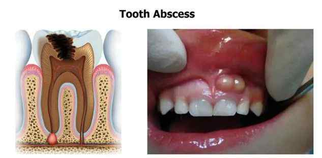 牙龈有白色的小脓包 牙龈出现白脓包，什么情况？