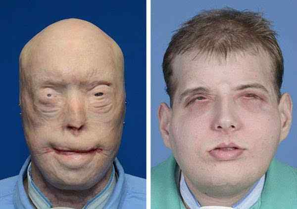 全脸移植 史上最强换脸术全过程 26小时移植全脸或终生疼痛
