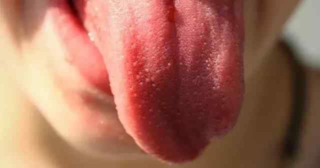 舌头出血是什么病征兆 舌头上出现斑点可能是严重疾病的征兆