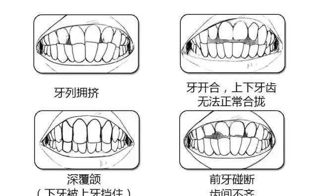 标准门牙咬合侧面图片 三步图测法了解你的牙齿是否需要矫正？
