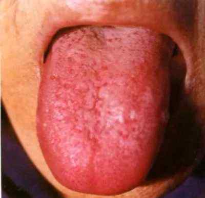 红绛舌 中医舌诊 | 红绛舌白花腻苔