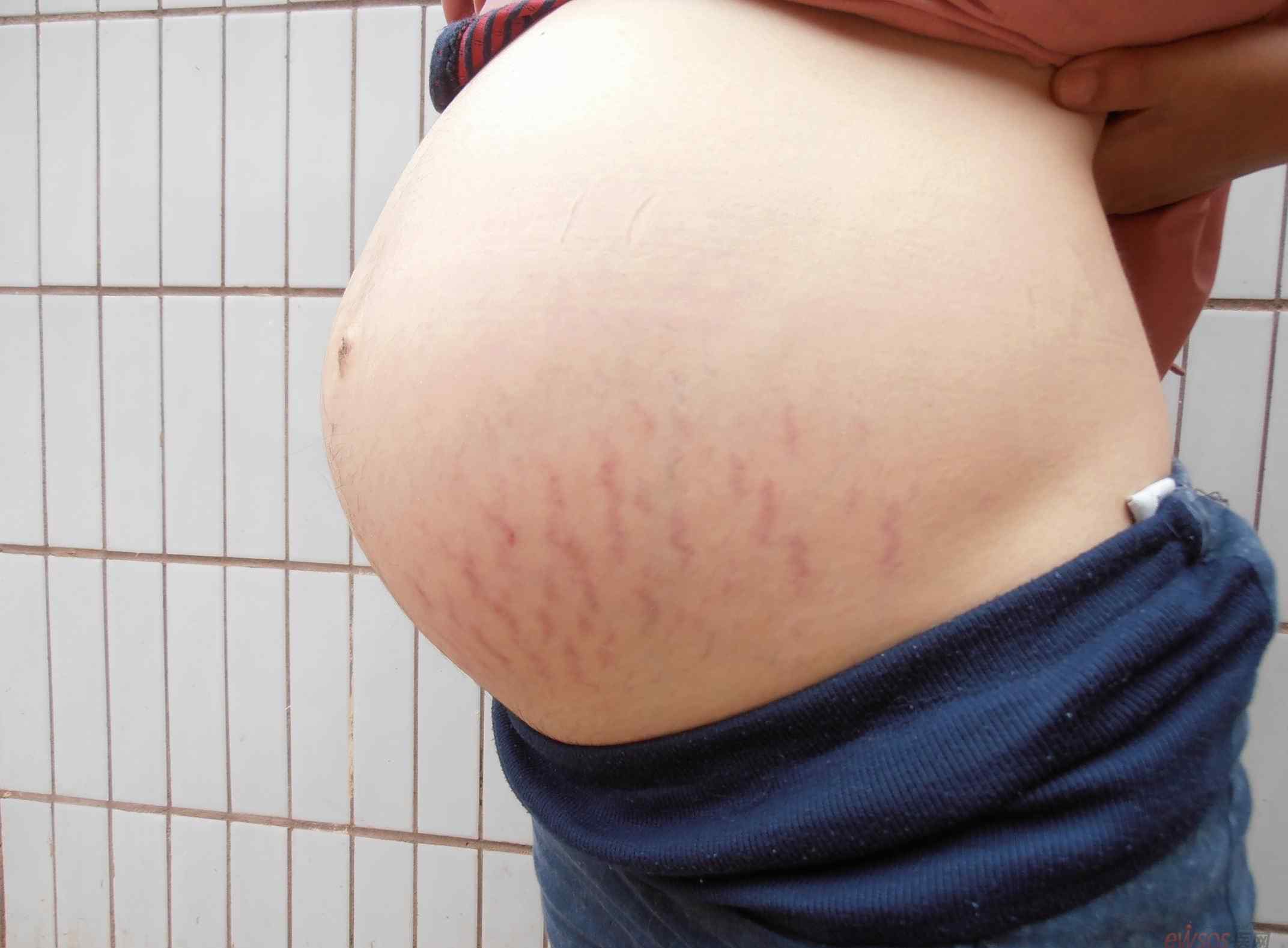 妊娠纹最开始的样子 妊娠纹最开始的样子