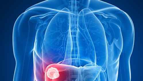 肝血管瘤能自愈吗 肝血管瘤能自愈吗?在饮食方面需要注意些什么?