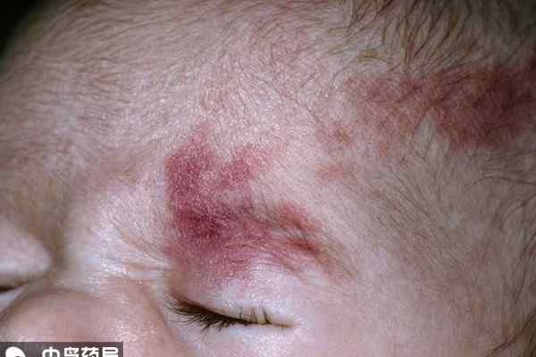 婴儿皮肤下血管瘤 婴儿皮肤上长红痣，可能是“血管瘤”，别傻傻以为是胎记