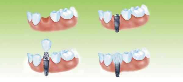 种植牙种牙 特别提醒这五种人慎选种植牙，否则后果很严重！
